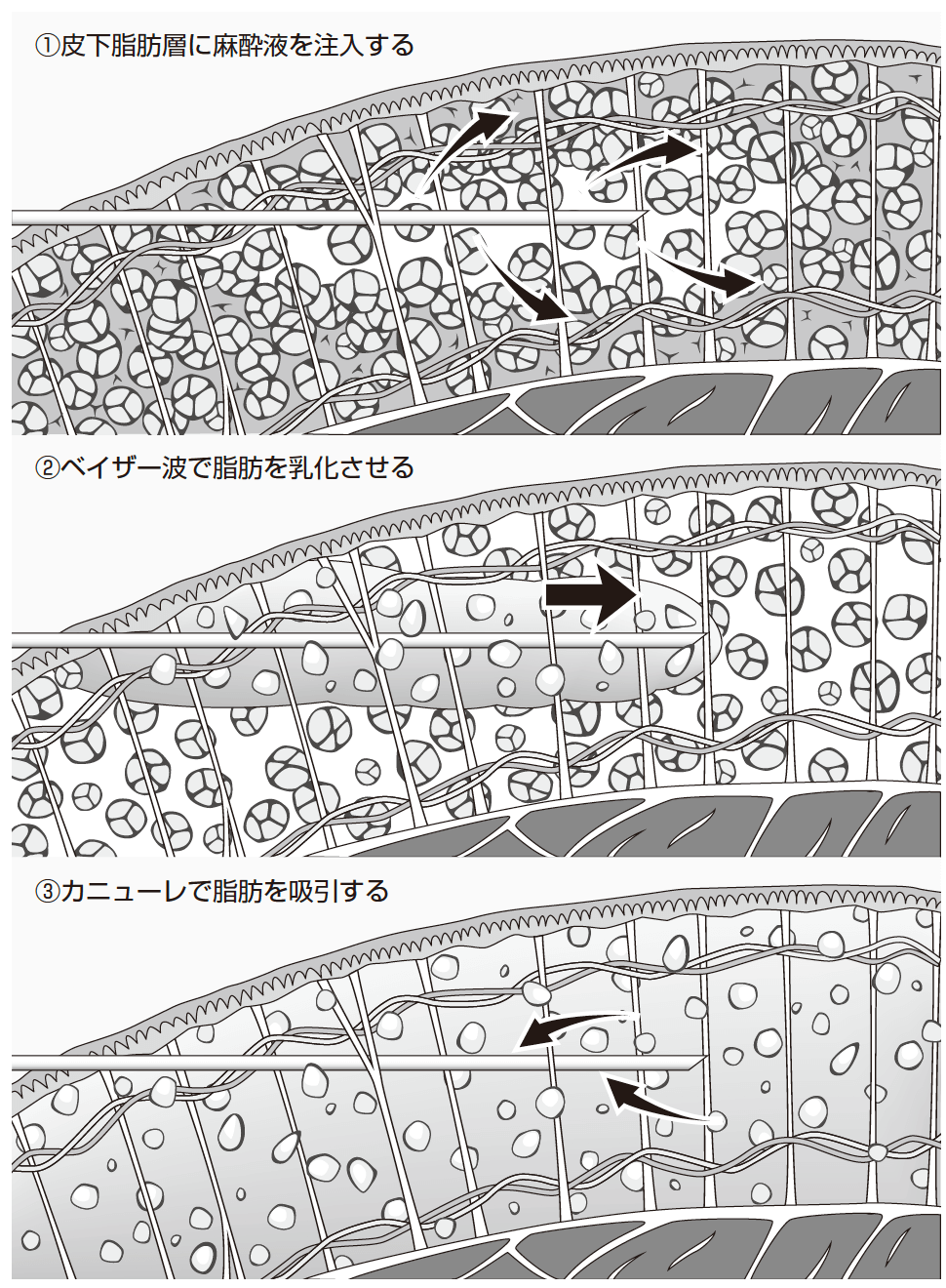 ①皮下脂肪層に麻酔液を注入する