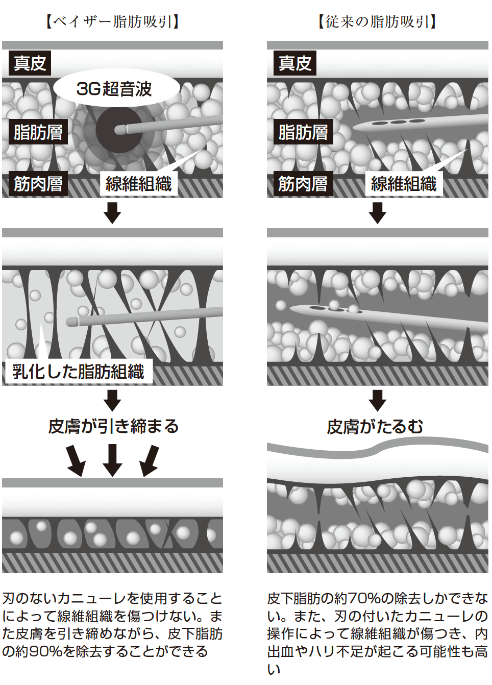 ②ベイザー波で脂肪を乳化させる