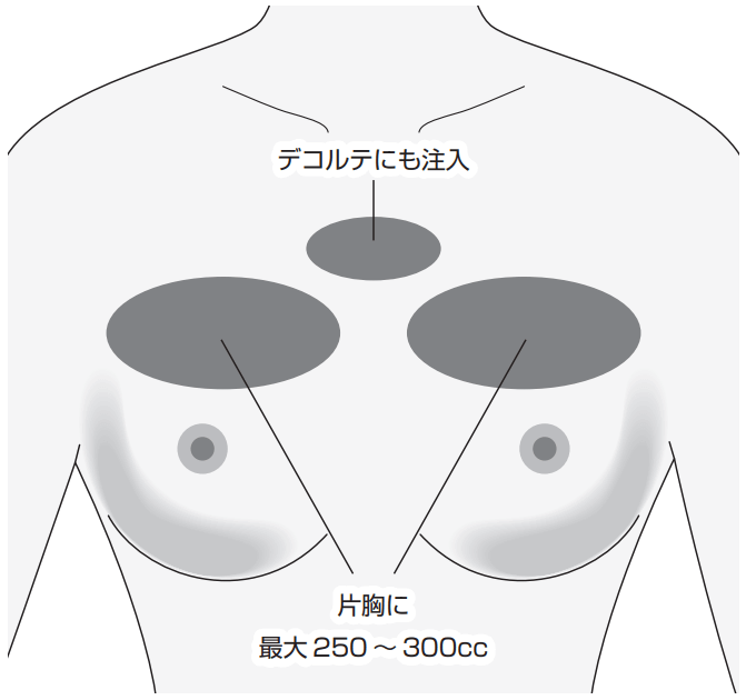 コンデンスリッチ豊胸の注入