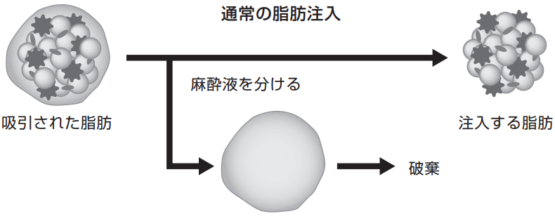 通常の脂肪注入