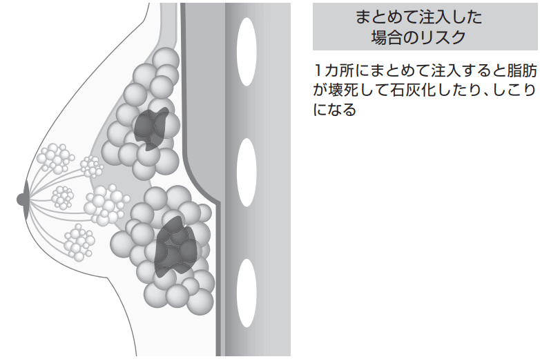 まとめて注入した場合のリスク