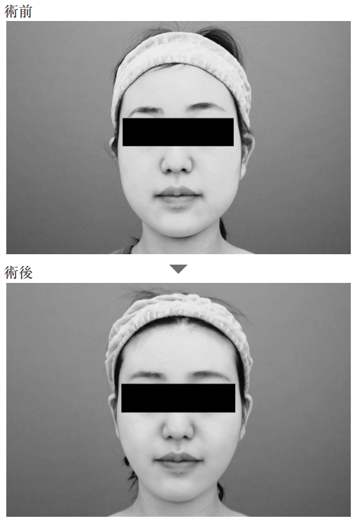 顔の脂肪吸引の事例２