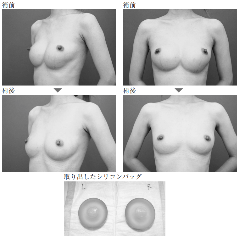 コンデンスリッチ豊胸でシリコンバッグを抜去した事例