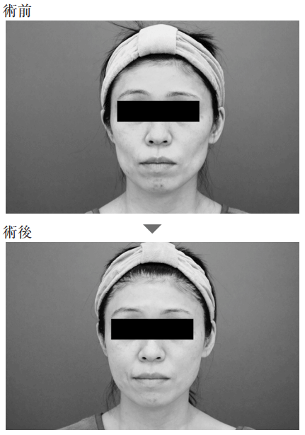 脂肪注入でエイジングケアをした事例