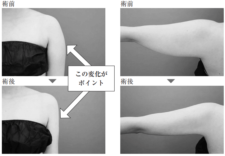 二の腕の脂肪吸引の事例5