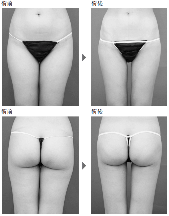 太ももの脂肪吸引の事例8