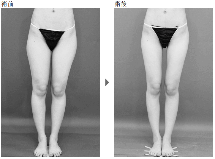 太ももの脂肪吸引の事例9
