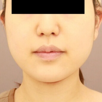頬・顎下の脂肪吸引／術前／3ヶ月 24歳女性の術前写真