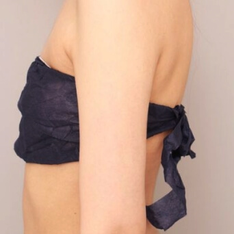 二の腕・肩の脂肪吸引【術後／1ヶ月 25歳女性】の術後写真