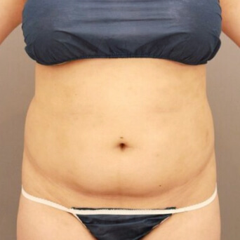 腹部全体＋腰の脂肪吸引【術前／6ヶ月 27歳女性】の術前写真
