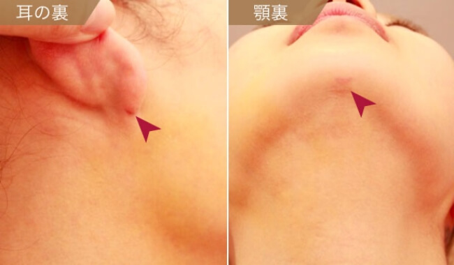 顔の傷跡の位置