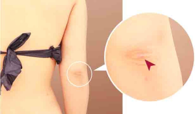 二の腕の傷跡の位置