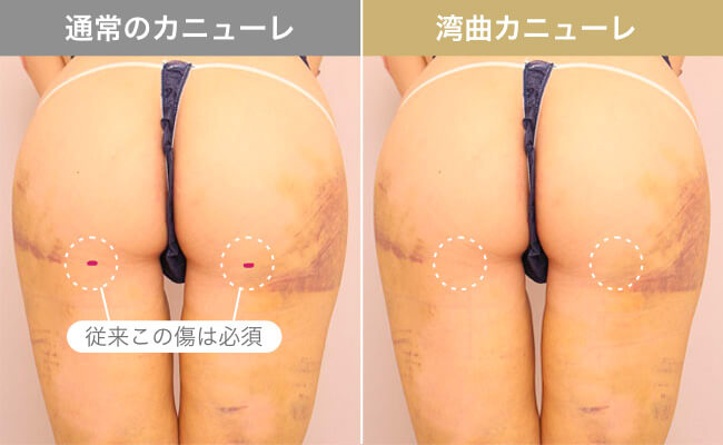 通常のカニューレと湾曲カニューレの傷の違い
