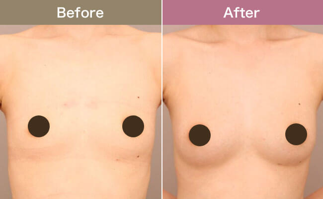 痩せ型でもバストのボリュームを確保できる