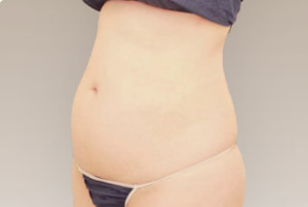 ベイザー脂肪吸引の術前症例サンプル