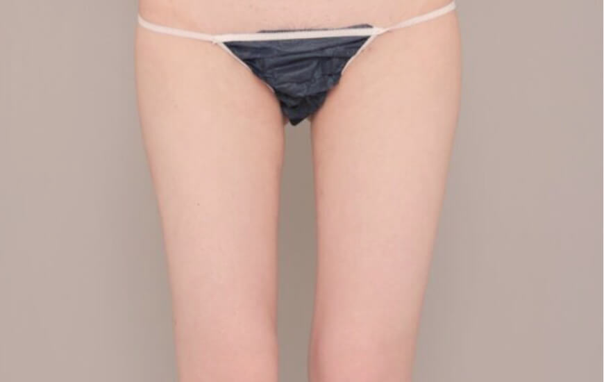 太もも全周＋お尻の脂肪吸引の術後写真