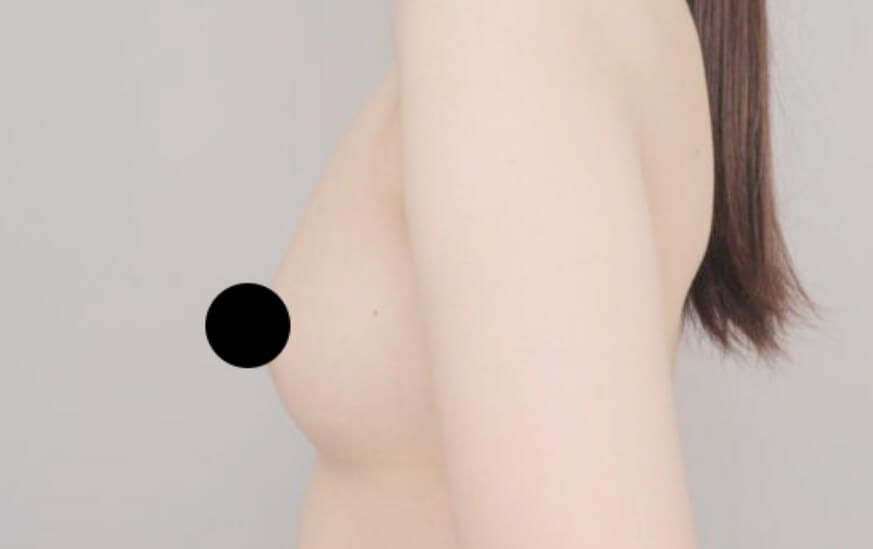コンデンスリッチ豊胸の術後写真