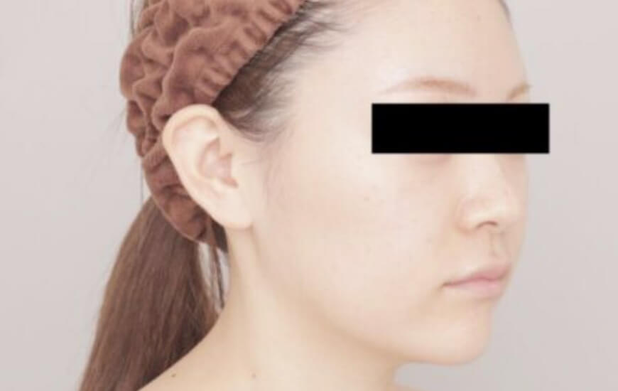 顔（頬＋顎下）の脂肪吸引の術前写真