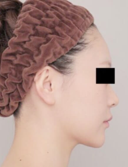 顔（頬＋顎下）の脂肪吸引の術後写真