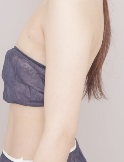 二の腕＋肩の脂肪吸引の術前写真