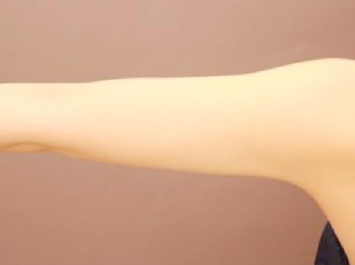 二の腕の脂肪吸引 比較写真術後 正面