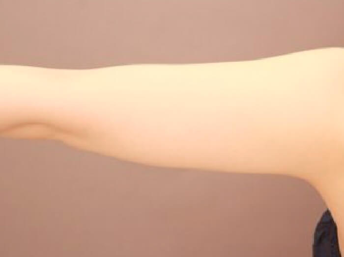 二の腕の脂肪吸引 比較写真術前 正面