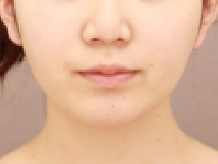 顔の脂肪吸引 比較写真術後 横
