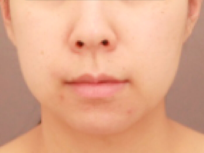 顔の脂肪吸引 比較写真術前 正面