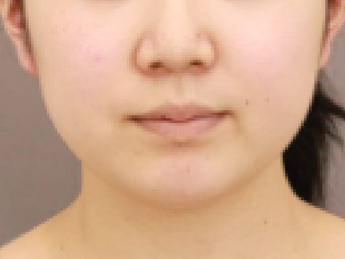 顔の脂肪吸引 比較写真術前 横