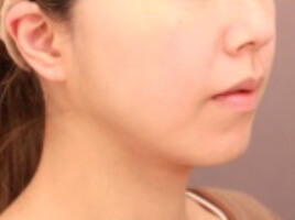 顔の脂肪吸引 術後半年写真２