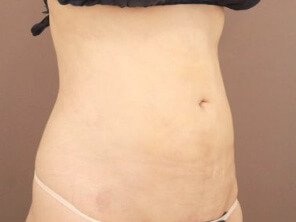 お腹の脂肪吸引 術後1ヶ月写真２
