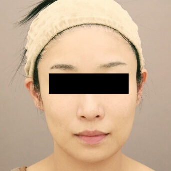 コンデンスリッチフェイス(頬のコケ)【女性［36歳］4ヶ月後】の術後写真