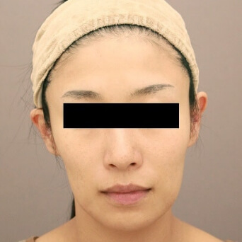 コンデンスリッチフェイス(頬のコケ)【女性［36歳］4ヶ月後】の術前写真
