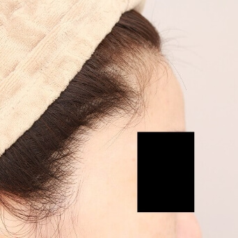 腹部全体+腰の脂肪吸引【術前/6ヶ月後 40歳女性】の術後写真