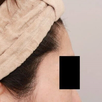 腹部全体+腰の脂肪吸引【術前/6ヶ月後 40歳女性】の術前写真