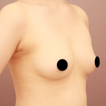 コンデンスリッチ豊胸【女性［28歳］3ヶ月】