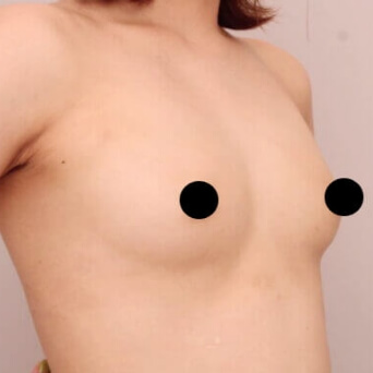 コンデンスリッチ豊胸【女性［20歳］6ヶ月】