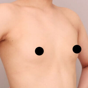 コンデンスリッチ豊胸【女性［20歳］6ヶ月】