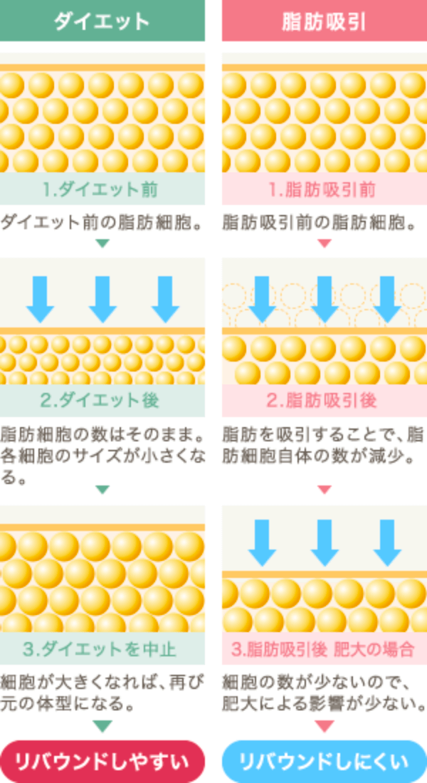 脂肪吸引とダイエットの違い