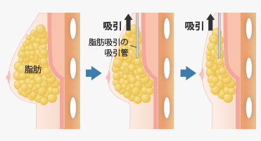 2.吸引