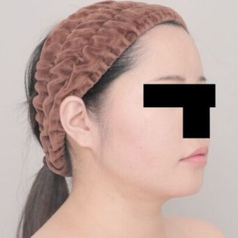 顔（頬・顎下）の脂肪吸引【術前／1ヶ月後 30歳女性】