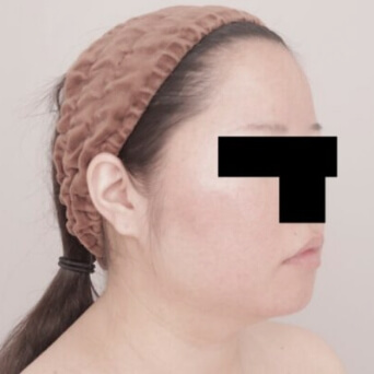 顔（頬・顎下）の脂肪吸引【術前／1ヶ月後 30歳女性】