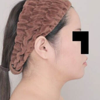 顔（頬・顎下）の脂肪吸引【術前／1ヶ月後 30歳女性】