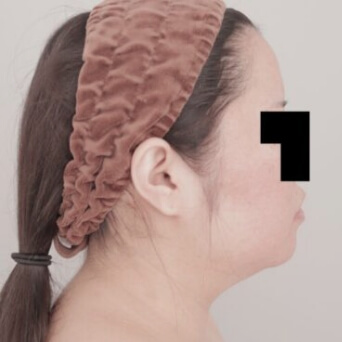 顔（頬・顎下）の脂肪吸引【術前／1ヶ月後 30歳女性】