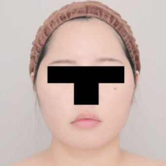 顔（頬・顎下）の脂肪吸引【術前／1ヶ月後 30歳女性】