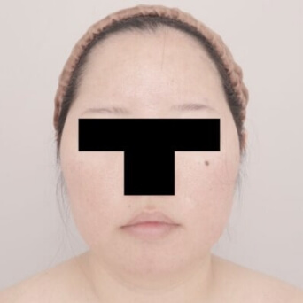 顔（頬・顎下）の脂肪吸引【術前／1ヶ月後 30歳女性】