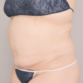 お腹・胸下・腰の脂肪吸引【術前／6ヶ月後 34歳女性】