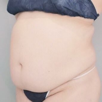 お腹・胸下・腰の脂肪吸引【術前／6ヶ月後 34歳女性】