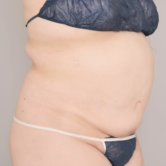 お腹・胸下・腰の脂肪吸引【術前／6ヶ月後 34歳女性】