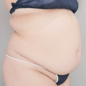 お腹・胸下・腰の脂肪吸引【術前／6ヶ月後 34歳女性】